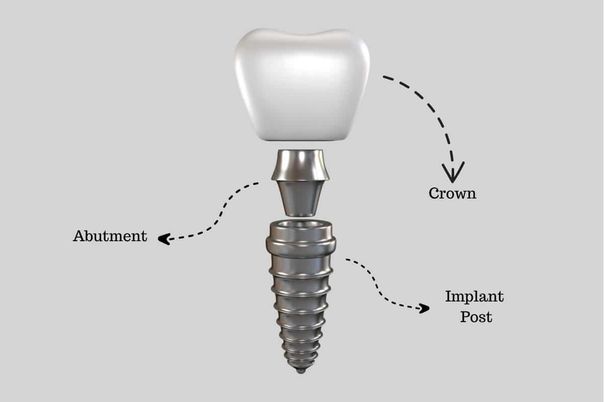 Dentist Supports